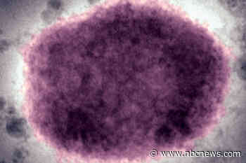 Monkeypox case identified in Massachusetts as outbreak grows in Europe