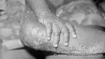 CDC: Monkeypox Case Reported in the U.S.