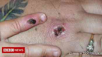 Monkeypox: Two more people infected to take total to nine in UK