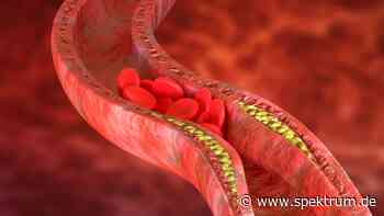 Atherosklerose: Gefäßschäden haben direkten Draht ins Hirn - Spektrum.de