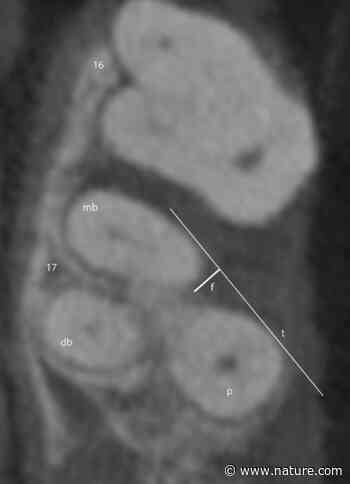 Imaging furcation defects with low-dose cone beam computed tomography | Scientific Reports - Nature.com