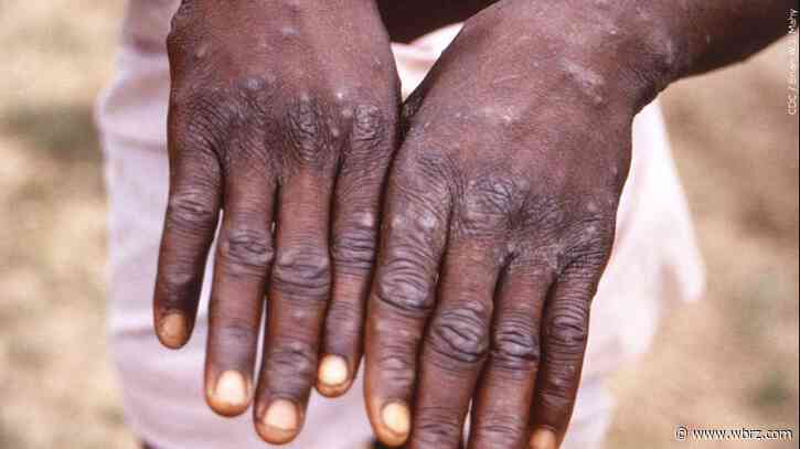 African scientists baffled by monkeypox cases in Europe, US