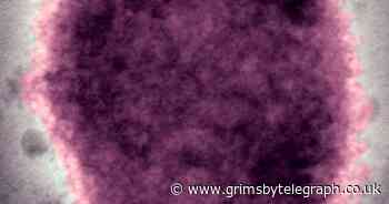 WHO plans emergency monkeypox meeting as UK outbreak doubles - Grimsby Live