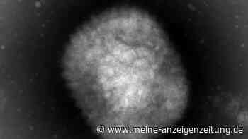 Affenpocken-Fall in Deutschland: Symptome, Übertragbarkeit und Risiko bei Infektion