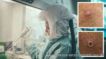 Affenpocken in Deutschland: Nach München zwei Fälle in Berlin - NRW beginnt Kontaktverfolgung
