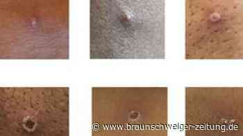 Affenpocken-Fälle in Berlin - Zahl der Nachweise steigt