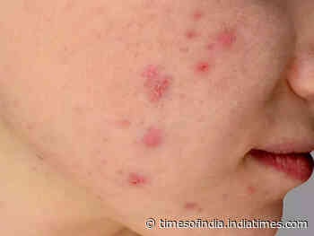 Monkeypox vs. Coronavirus: How the two infections differ - Times of India