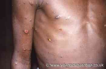 Monkeypox virus UK: What happens if you get infected?
