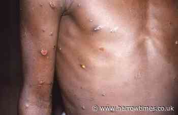 Monkeypox virus UK: What happens if you get infected?