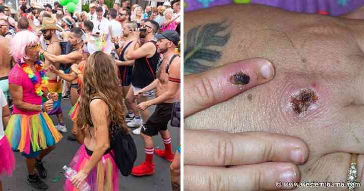 Monkeypox Outbreaks Being Linked to LGBT Pride Parade, Fetish Festival