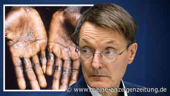 Affenpocken: Zwei neue Fälle, Bayern schickt Kontaktpersonen in Quarantäne - Lauterbach will „hart reagieren“