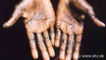 Angst vor neuer Pandemie: Diese Symptome deuten auf Affenpocken hin - Lauterbach prüft Impfempfehlung | shz.de - shz.de