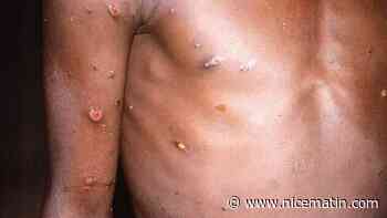 Trois cas suspects de variole du singe détectés au Maroc