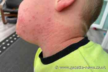Caterpillar rash: Mum's warning to parents after brown tail moth leaves son with rash