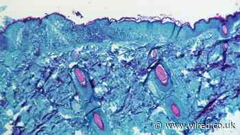 The Mystery of Monkeypox’s Global Spread