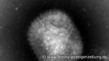 Weltweite Ausbreitung von Affenpocken: Auch in Hessen Infektion nachgewiesen
