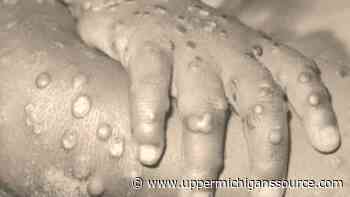 Marquette County Health Department: 'Monkeypox isn't the next coronavirus' - WLUC