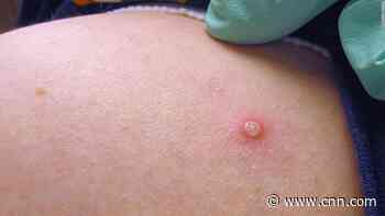 Monkeypox has made its way to the US. These are the symptoms to look out for