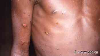 Confirmed monkeypox cases in Quebec climb to 15