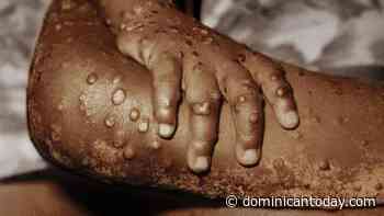 Dominican Medical College warns that monkeypox could reach the country - Dominican Today