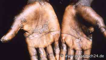 Affenpocken: So schützen Sie sich am besten