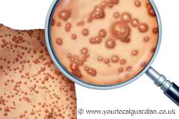 UK monkeypox outbreak: How to tell the difference between chickenpox and monkeypox