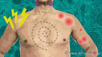 Virologe erklärt nötige Maßnahmen gegen Affenpocken: „Nicht der Beginn einer neuen Pandemie“