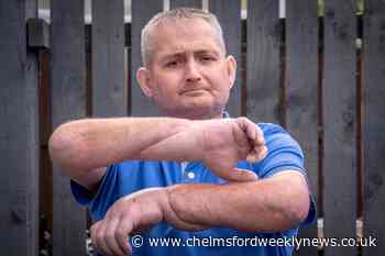 Man has double hand transplant in 'world first' for scleroderma patient - Chelmsford Weekly News