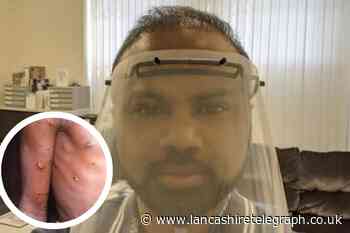 Haslingden doctor answers questions about monkeypox virus