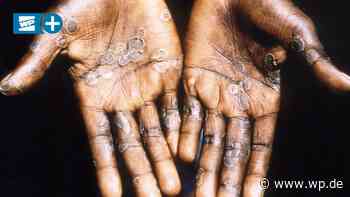 Meschede: Werden Affenpocken bald auch im HSK zum Problem? - WP News