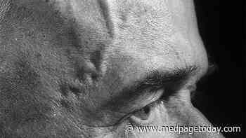 Giant Cell Arteritis Growing More Lethal