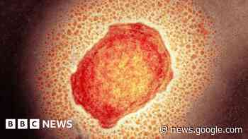 Monkeypox: First case confirmed in Northern Ireland - BBC