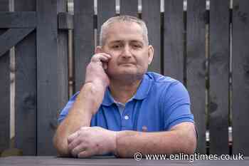 Man undergoes 'world first' double hand transplant for scleroderma - Ealing Times