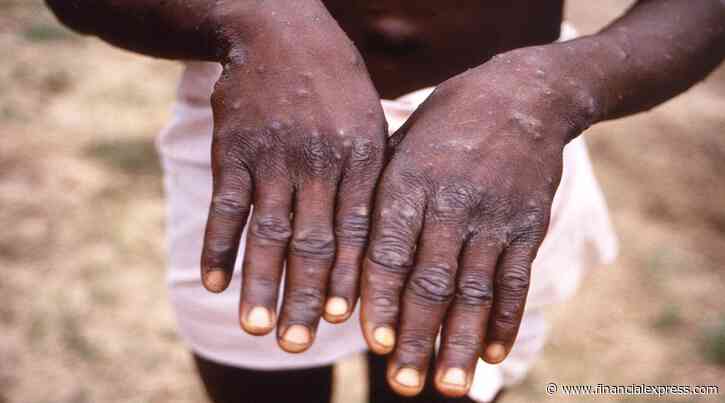 WHO: Nearly 200 cases of monkeypox in more than 20 countries