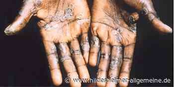 So wappnet sich Hildesheim für die Affenpocken - www.hildesheimer-allgemeine.de