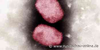 Affenpocken: Karl Lauterbach über Lage in Deutschland – Verdacht in Aachen - Kölnische Rundschau