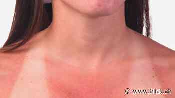 Aligro-Werbung zu Sonnenbrand sorgt für Kopfschütteln bei Krebsliga - BLICK