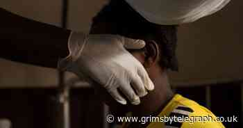 Blister warning as UK monkeypox cases soar to 106 - Grimsby Live - Grimsby Live