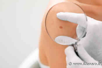 Attenti al neo! Torna a Capri la prevenzione targata Lilt - Ildenaro.it - Il Denaro