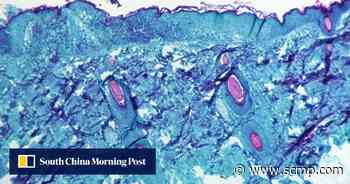 Monkeypox: Don’t make same mistake as coronavirus, say experts - South China Morning Post