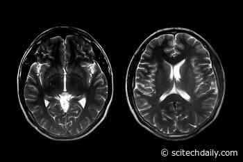 Changes in Brain’s Visual Processing Areas in Infancy Before Autism Diagnosis