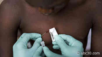 WHO: Monkeypox won't turn into pandemic, but many unknowns