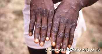 WHO expert on what to expect next in monkeypox outbreak - Grimsby Live - Grimsby Live