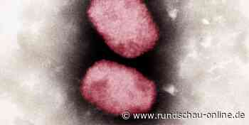Affenpocken: 21 Fälle in sechs Bundesländern – Lauterbach erwartet Impfstoff an Juni - Kölnische Rundschau