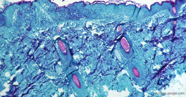 Unlikely monkeypox outbreak will lead to pandemic, WHO says - Reuters