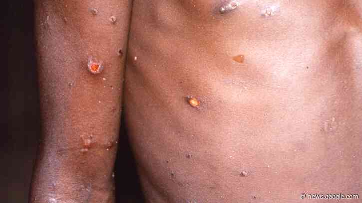 Monkeypox, First Possible Human-to-Human Transmission Spotted in U.S. - TMZ