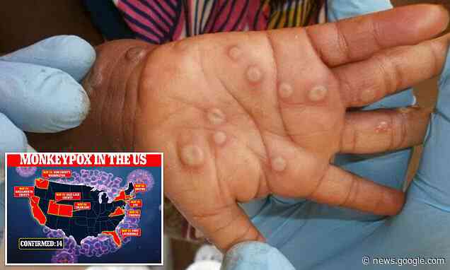 Monkeypox patient in Massachusetts suffered fluid-filled blisters on scalp, palms and feet - Daily Mail