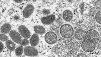 Monkeypox: Dr Gupta explains how it spreads and what the symptoms are