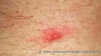 Affenpocken-Virus hat Niedersachsen erreicht