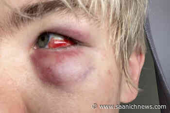 Man charged in alleged homophobic assault at BC house party – Saanich News - Saanich News